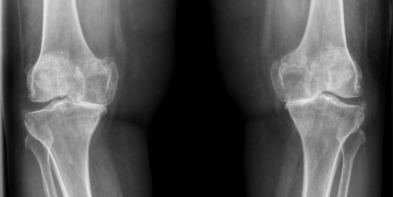 osteoarthirites.jpg